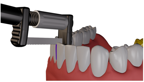 Strauss’ Innovative Magic Strip™ System
