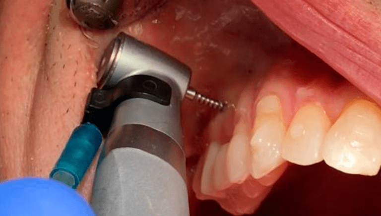 Actify Orthodontic Drill