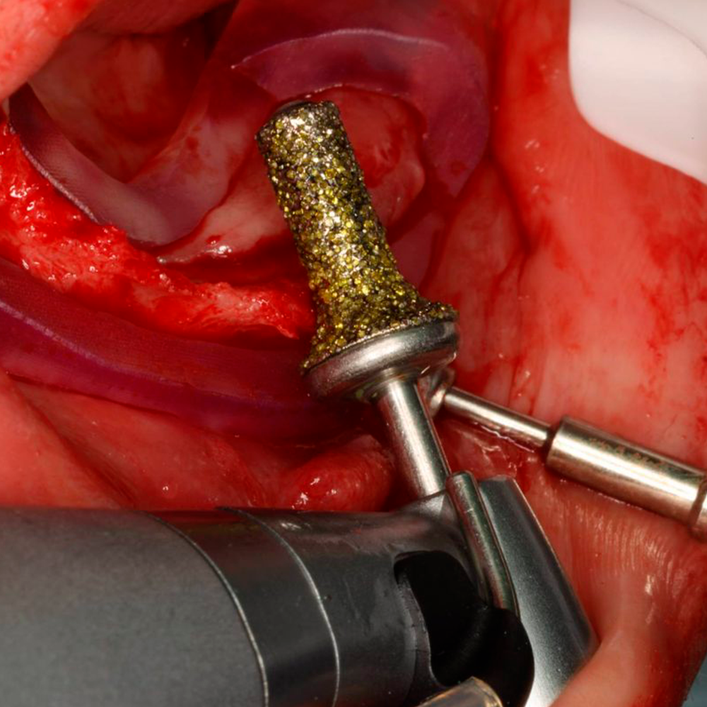 Bone Reduction Bur