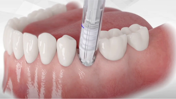 Augma Bone Graft Cement