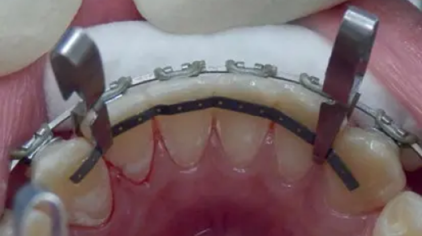Lingual Retention Wire