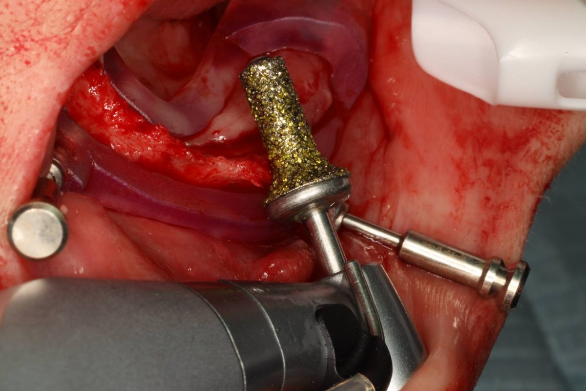 BRB427 - Bone Reduction Bur 1/PK