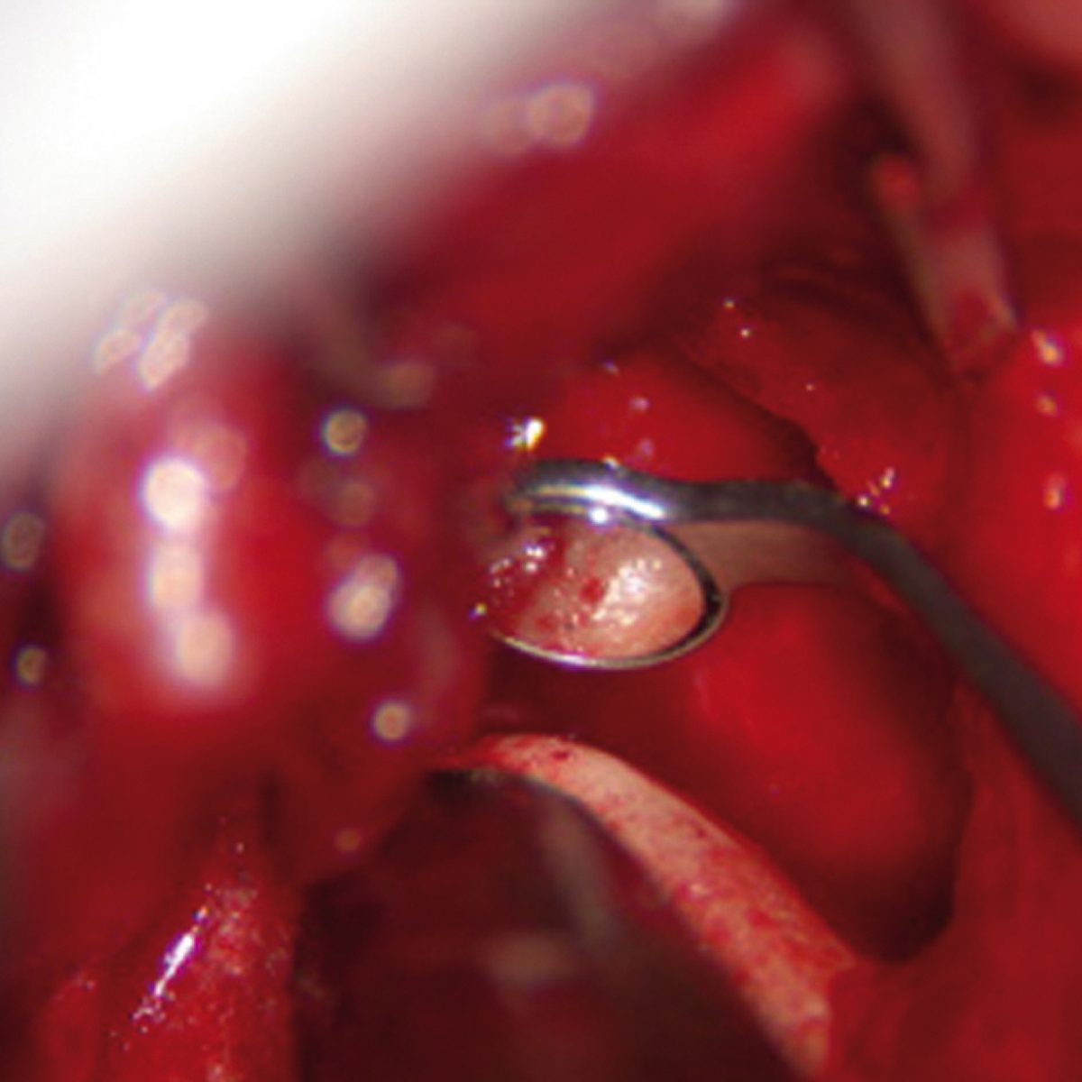 HD ULTRAmicro Ultra Bright FS Micro-Surgery Mirror
