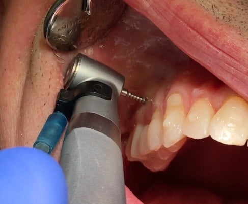 Actify – Orthodontic Drill Image 3 - Strauss Diamond Instruments, Inc.