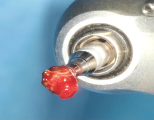 Degranulation Suction