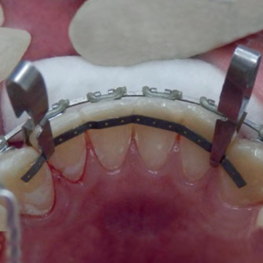 Lingual Retention Wire Set