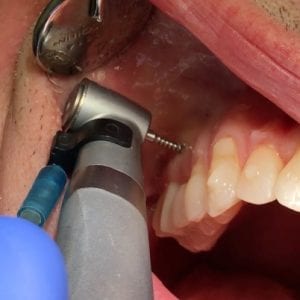 Actify – Orthodontic Drill