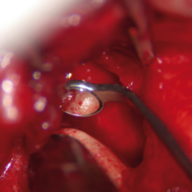 Micro Surgery Mirror