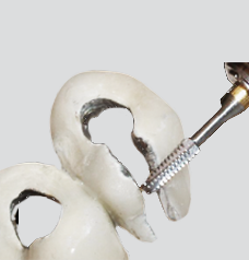 Endo Access on PFM/Amalgam