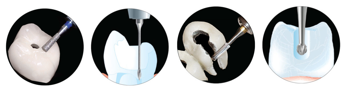 The Key to Endo Access