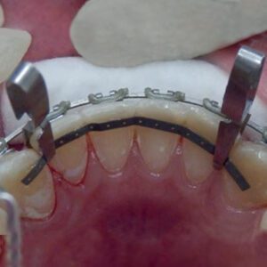 Lingual Retention Wire Set